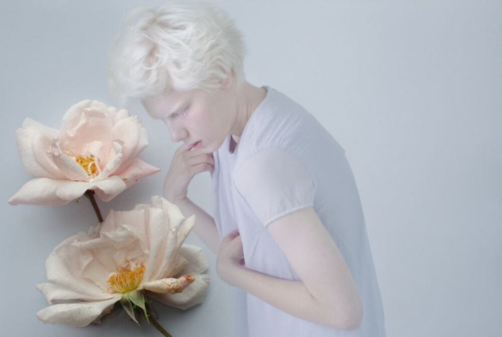 albinism