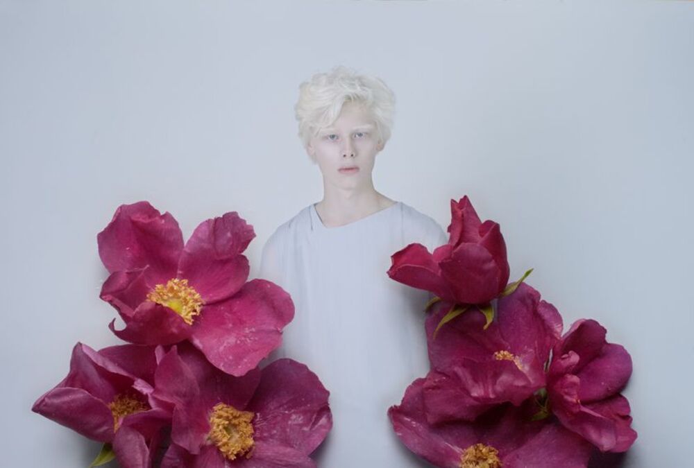 albinism