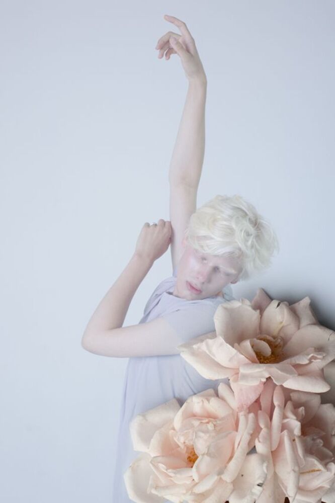 albinism