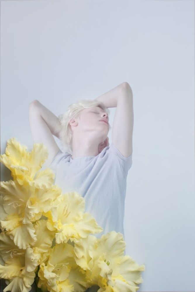 albinism