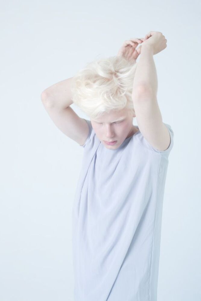 albinism