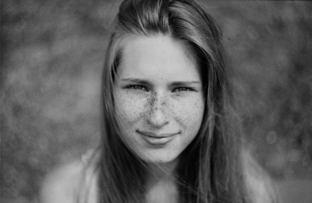 freckle