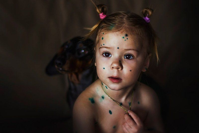 Ветрянка фото превью