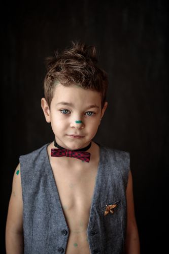 Удивление ветрянки