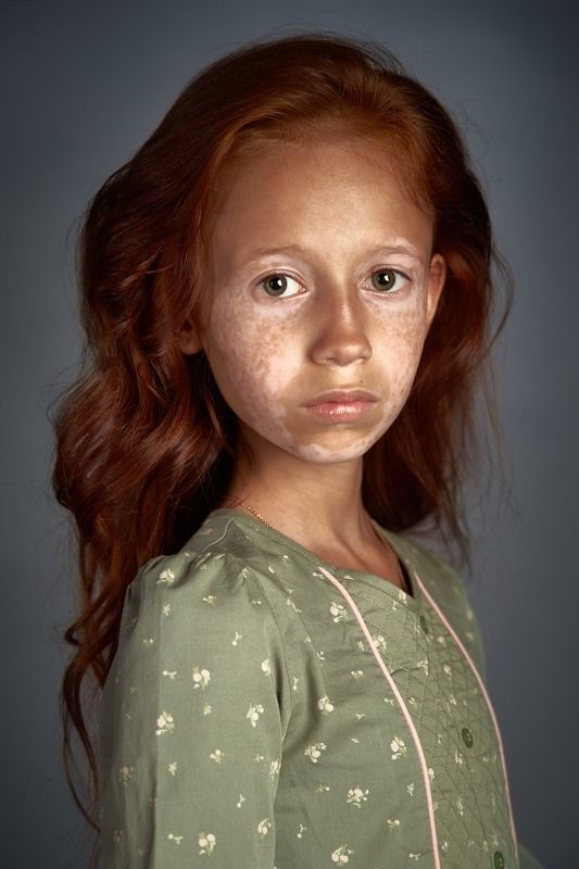 портрет, девочка, дети, витилиго, рыжая, серия, студия, Диана фото превью