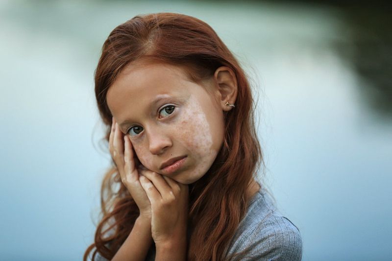 портрет, витилиго, модель, дети Диана фото превью