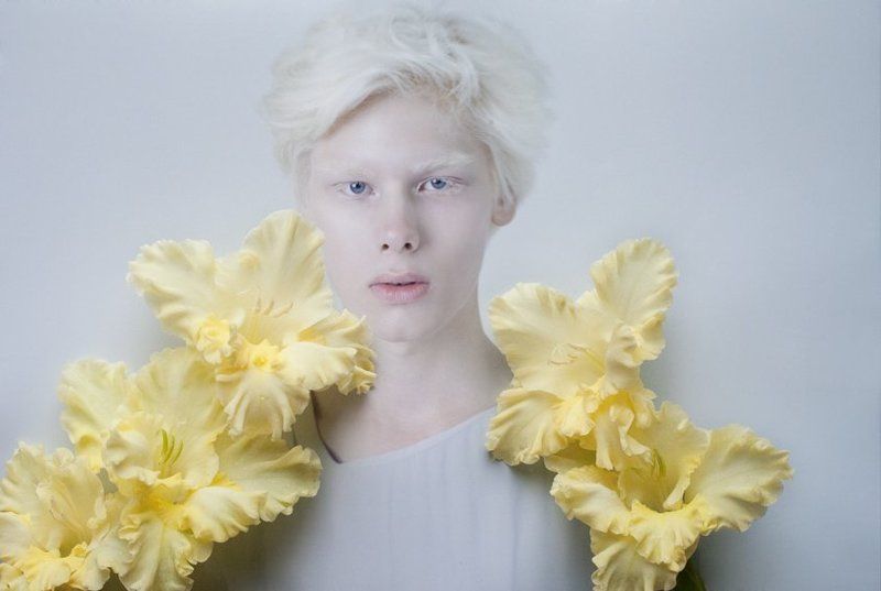 albinism фото превью
